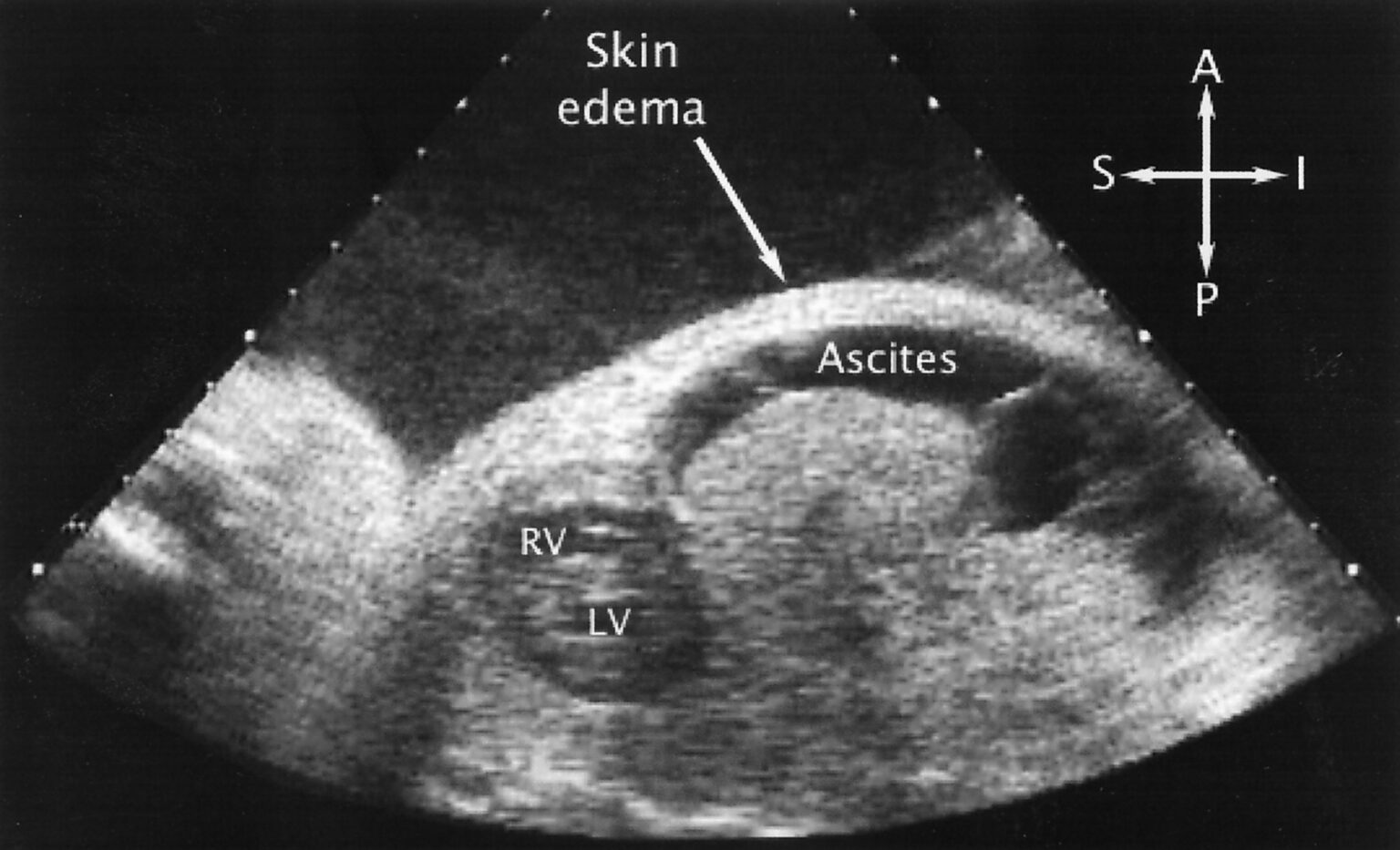 Nonimmune Hydrops Fetalis Paras Fetal Medicine 